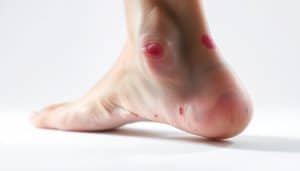 A close-up view of a swollen, discolored ankle joint, with visible bruising and inflammation. The limb is positioned against a stark, clinical white background, illuminated by soft, diffused lighting that accentuates the textures and details of the injury. The image conveys a sense of acute trauma, with a focus on the specific physical characteristics that would be associated with a sports-related injury, such as a sprain or strain.